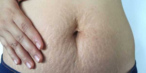 What Can Be Done About Postpartum Body Image Struggles?